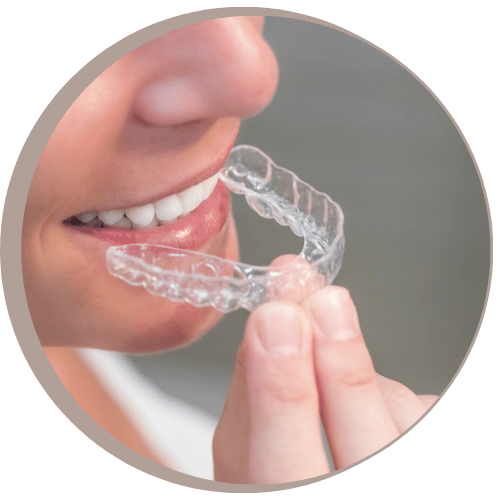 Usynlig tannregulering